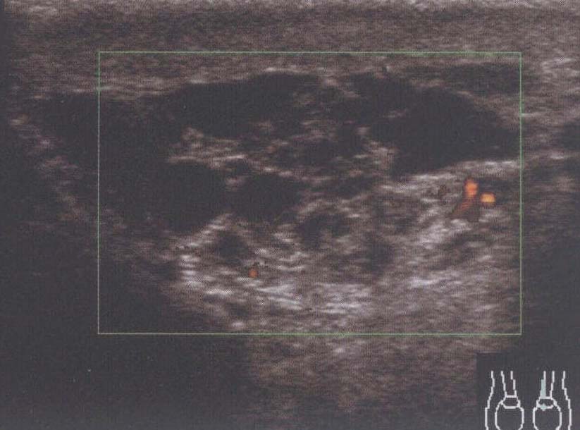 精子囊腫